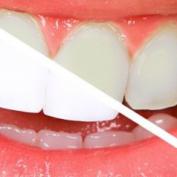 Sbiancamento denti Bari