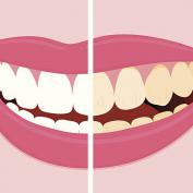 Sbiancamento denti Cuneo